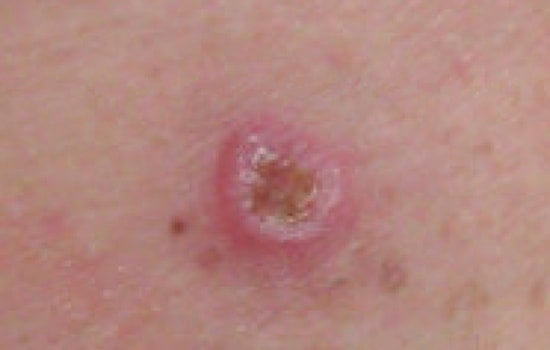 Utah Melanoma Shock: Nation's Highest Skin Cancer Rate Isn't About Sun