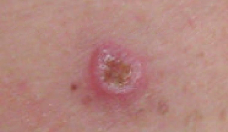 Utah Melanoma Shock: Nation's Highest Skin Cancer Rate Isn't About Sun