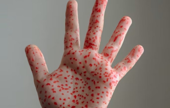 Vaccinated Delta County Toddler’s Measles Case Sparks Fears Of Hidden Outbreak