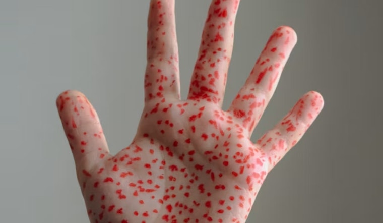 Vaccinated Delta County Toddler’s Measles Case Sparks Fears Of Hidden Outbreak