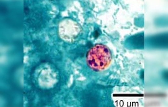 Diarrhea Parasite Invades Georgia As Summer Surge Spooks Health Officials