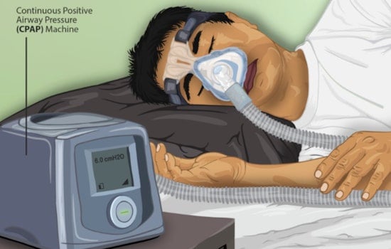Docs Warn Ignored Sleep Apnea Speeds Seniors' Cognitive Decline by 69 Percent