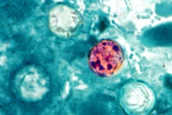 Galveston Cyclospora Scare as 14 Cases Confirmed, More Probed