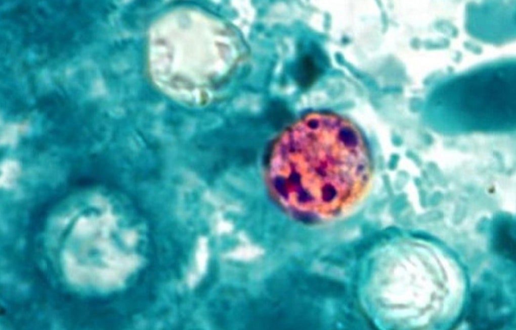 Galveston Cyclospora Scare as 14 Cases Confirmed, More Probed