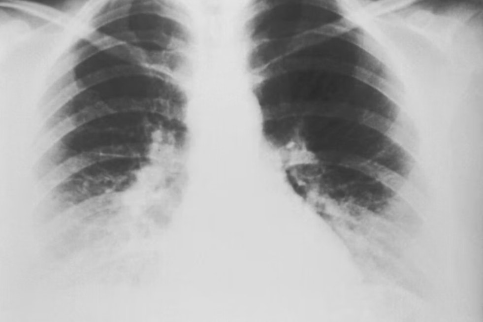 Lung Cancer Stigma in Boston, Doctors Warn