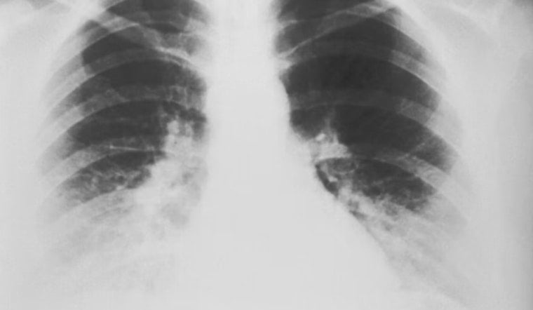 Lung Cancer Stigma in Boston, Doctors Warn