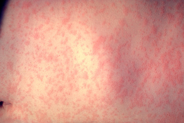 Maryland Measles Count Hits 12 As Carroll Hospital ER Alert Goes Out