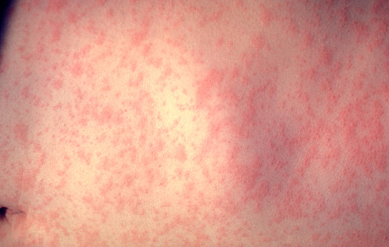 Maryland Measles Count Hits 12 As Carroll Hospital ER Alert Goes Out