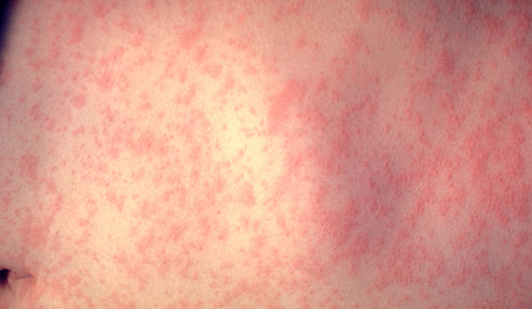 Maryland Measles Count Hits 12 As Carroll Hospital ER Alert Goes Out