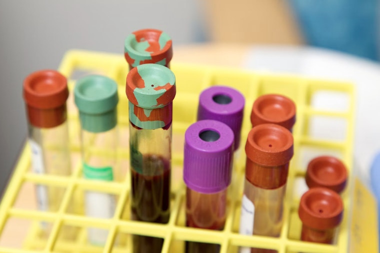 Milwaukee Scientists Eye Game-Changing Alzheimer’s Blood Test