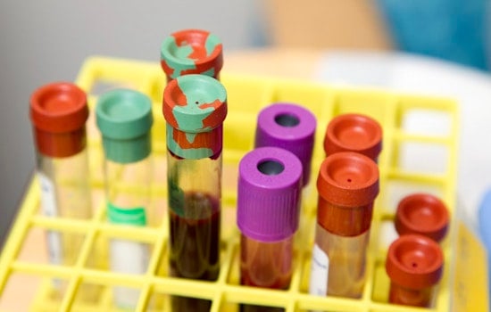 Milwaukee Scientists Eye Game-Changing Alzheimer’s Blood Test