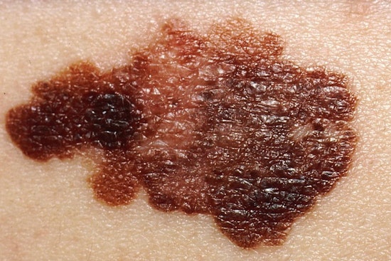 Ohio Melanoma Surge As Gen Z Keeps Frying For The ’Gram