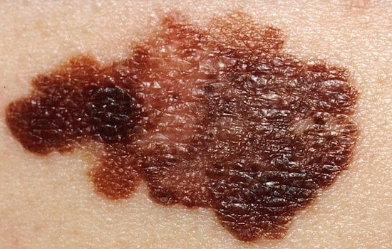 Ohio Melanoma Surge As Gen Z Keeps Frying For The ’Gram