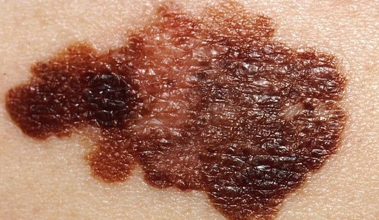 Ohio Melanoma Surge As Gen Z Keeps Frying For The ’Gram