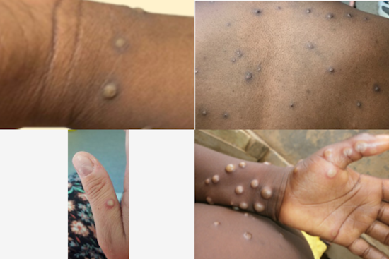 Traveler Brings Harsher Mpox Strain to Arizona, State Ramps Up Hunt for Exposures
