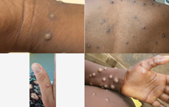 Traveler Brings Harsher Mpox Strain to Arizona, State Ramps Up Hunt for Exposures