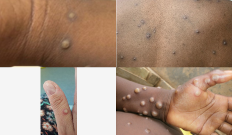 Traveler Brings Harsher Mpox Strain to Arizona, State Ramps Up Hunt for Exposures