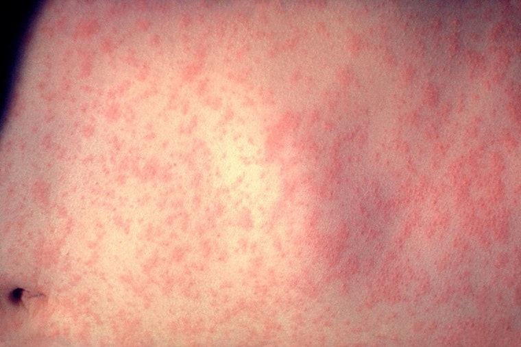 Dallas County's First Measles Case Hits Allen, Fairview, Frisco Spots