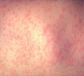 Dallas County's First Measles Case Hits Allen, Fairview, Frisco Spots