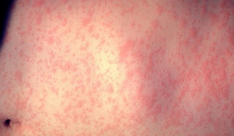 Dallas County's First Measles Case Hits Allen, Fairview, Frisco Spots