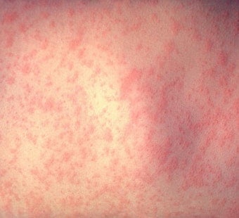 Kane County Confirms Measles Case as US Infections Hit 35-Year High