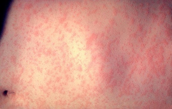 Kane County Confirms Measles Case as US Infections Hit 35-Year High
