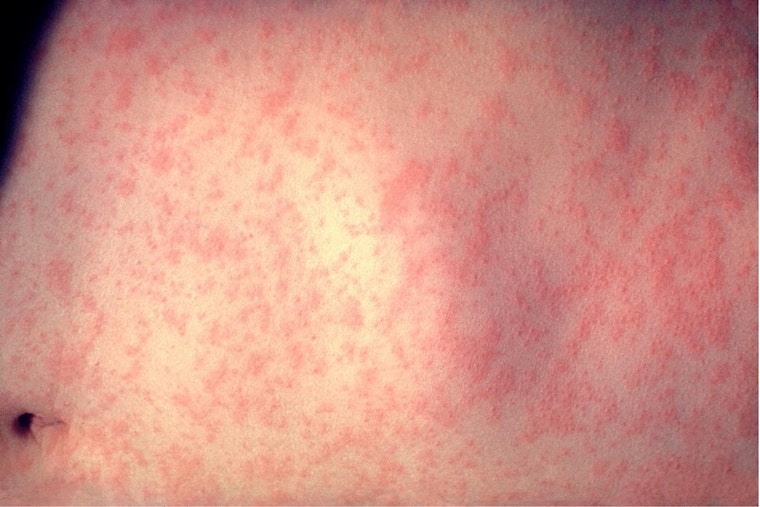 Measles Madness: El Paso Launches Back-to-School Vaccine Blitz as U.S. Cases Top 2,300