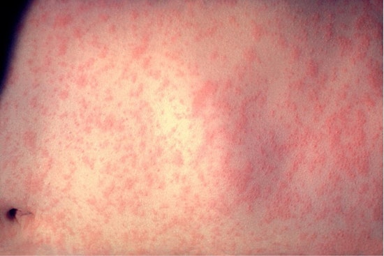 Measles Madness: El Paso Launches Back-to-School Vaccine Blitz as U.S. Cases Top 2,300