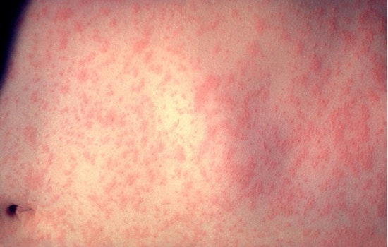 Measles Madness: El Paso Launches Back-to-School Vaccine Blitz as U.S. Cases Top 2,300