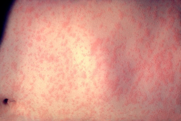 Metro Atlanta Measles Case Confirmed as Georgia Hits Six for 2026