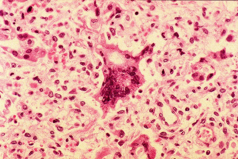 Orange County Measles Case Sparks Exposure Alerts at Anaheim, Fountain Valley Sites