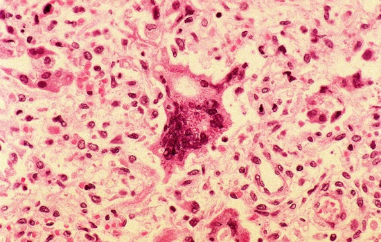 Orange County Measles Case Sparks Exposure Alerts at Anaheim, Fountain Valley Sites