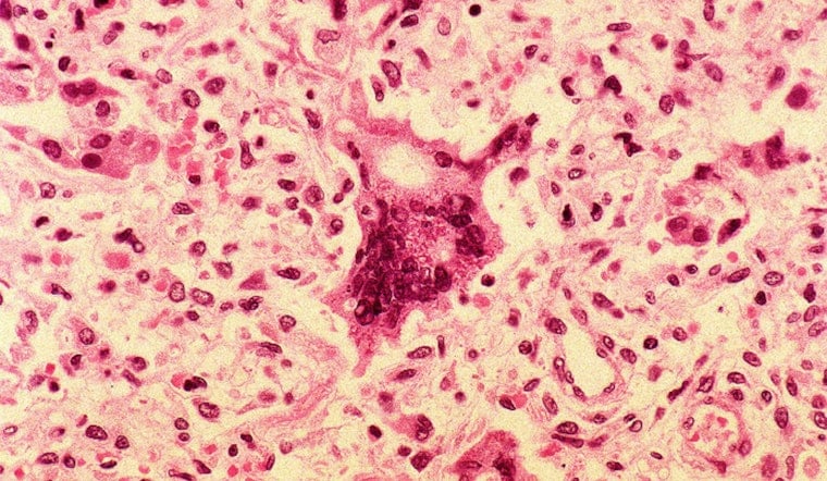 Orange County Measles Case Sparks Exposure Alerts at Anaheim, Fountain Valley Sites