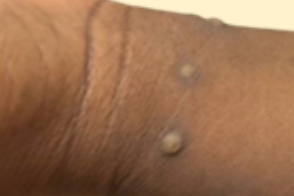 San Diego County Confirms First Clade I Mpox Case Tied to Overseas Travel