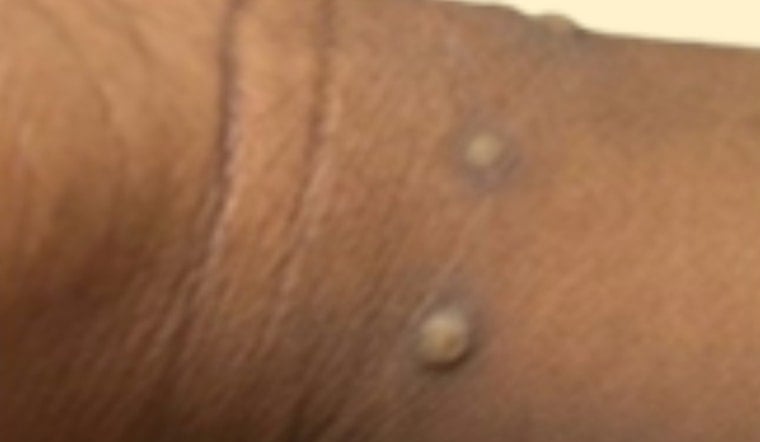 San Diego County Confirms First Clade I Mpox Case Tied to Overseas Travel