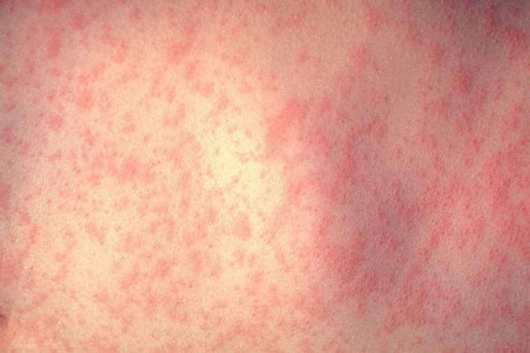 Five Jasper County Siblings Test Positive for Measles as Georgia Cases Climb