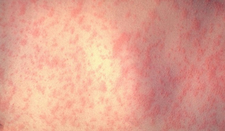 Five Jasper County Siblings Test Positive for Measles as Georgia Cases Climb