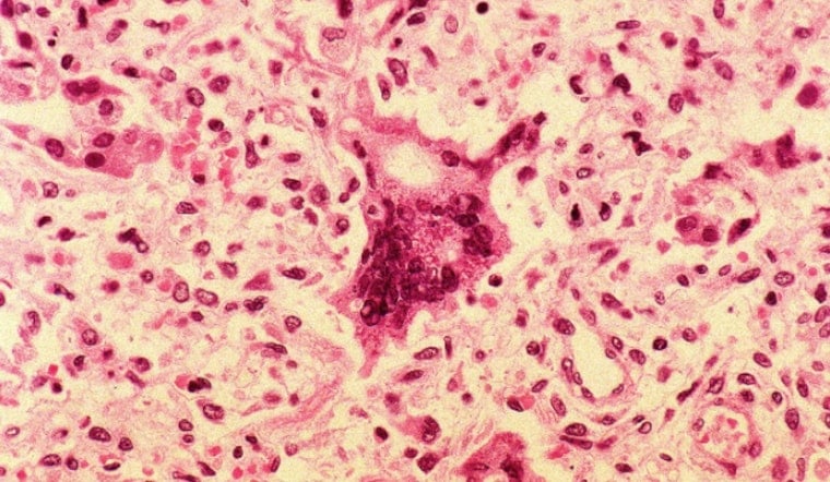 Lakeville Pediatrician Won't Turn Away Vaccine-Skeptical Families, Even as Measles Deaths Rise