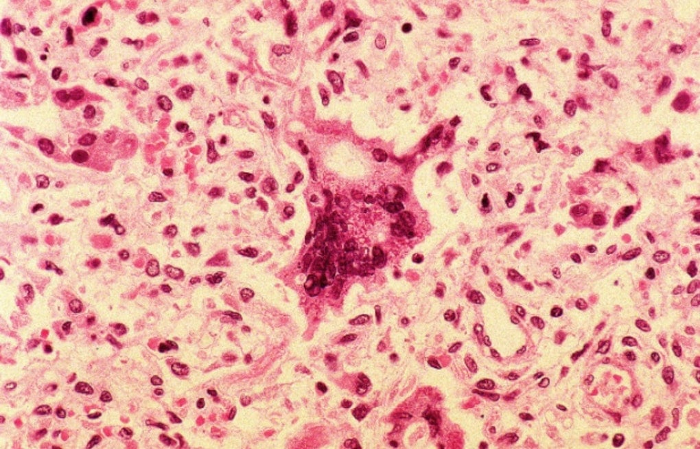 Lakeville Pediatrician Won't Turn Away Vaccine-Skeptical Families, Even as Measles Deaths Rise