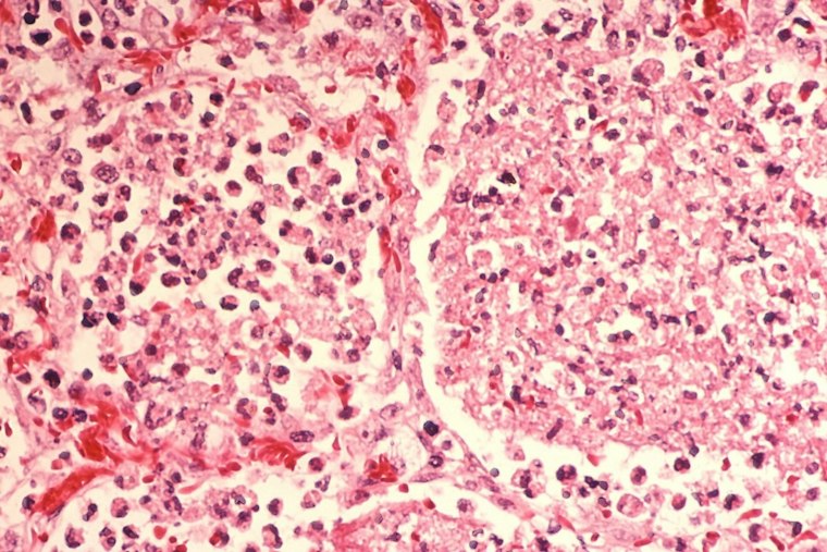 Legionella Found in Evanston Hilton Garden Inn Hot Tub After Two Fall Ill