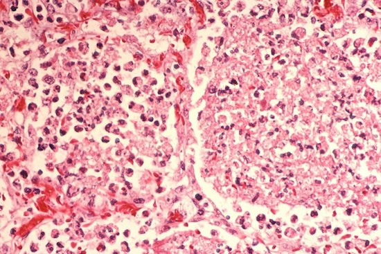Legionella Found in Evanston Hilton Garden Inn Hot Tub After Two Fall Ill