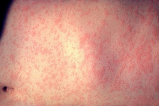 Measles Outbreak Hits Douglas County as Illinois Cases Climb to Nine
