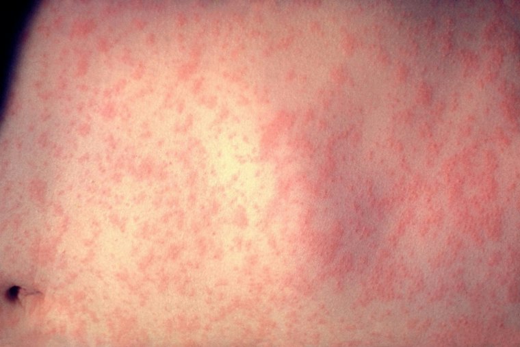 St. Louis County Confirms First Measles Case in 20 Years, Even in Vaccinated Patient