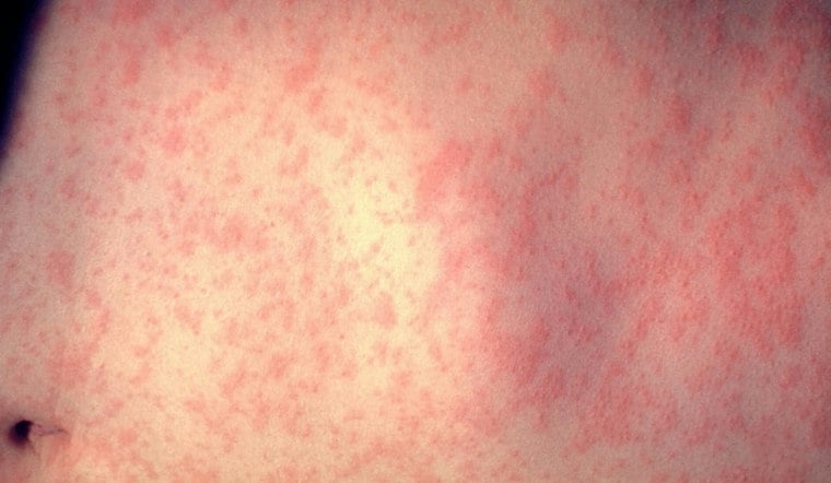 St. Louis County Confirms First Measles Case in 20 Years, Even in Vaccinated Patient