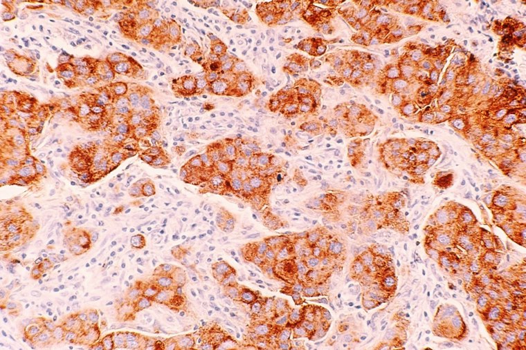 UCSF Study Finds Dense Breast Tissue Triggers DNA-Damaging Chemical Chain
