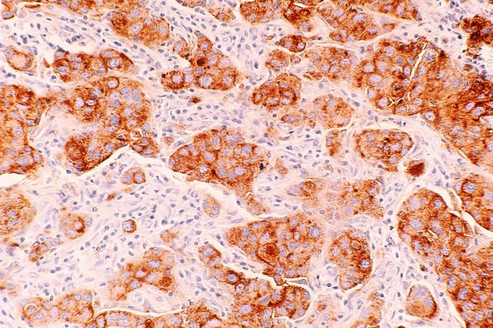 UCSF Study Finds Dense Breast Tissue Triggers DNA-Damaging Chemical Chain
