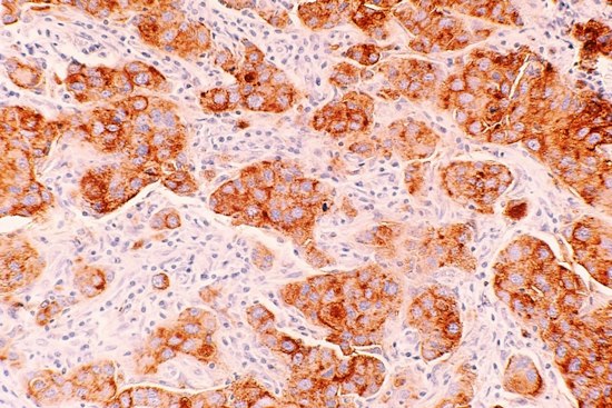UCSF Study Finds Dense Breast Tissue Triggers DNA-Damaging Chemical Chain