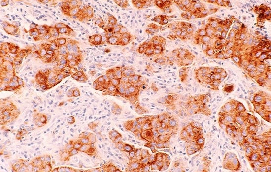 UCSF Study Finds Dense Breast Tissue Triggers DNA-Damaging Chemical Chain