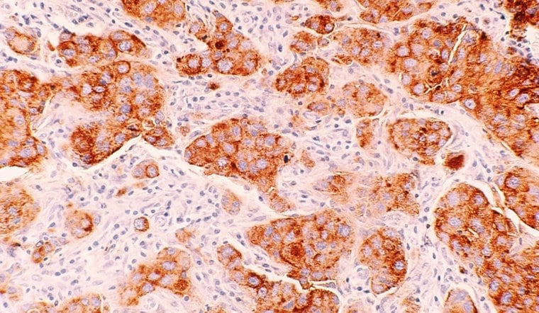 UCSF Study Finds Dense Breast Tissue Triggers DNA-Damaging Chemical Chain