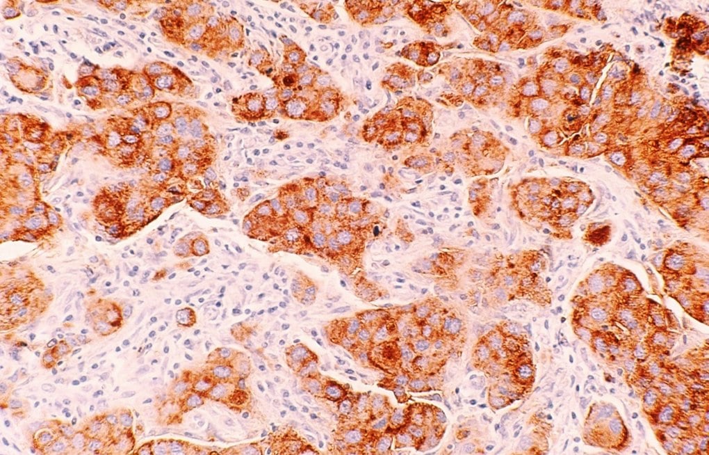 UCSF Study Finds Dense Breast Tissue Triggers DNA-Damaging Chemical Chain
